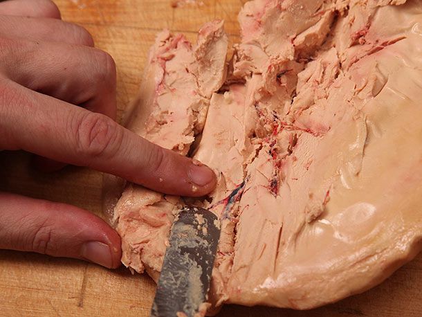 Close-up of author revealing additional veins in the liver with his fingers and the offset spatula. 